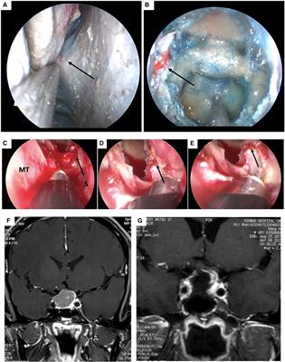 Incidence, risk factors, management and prevention of severe postoperative epistaxis after endoscopic endonasal transsphenoidal surgery: a single center experience